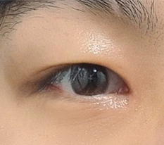 目頭切開失敗後..