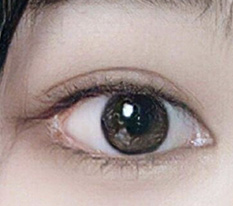 デュアル目尻切開して2ヶ月経ちましたが、うまくいってますよね??