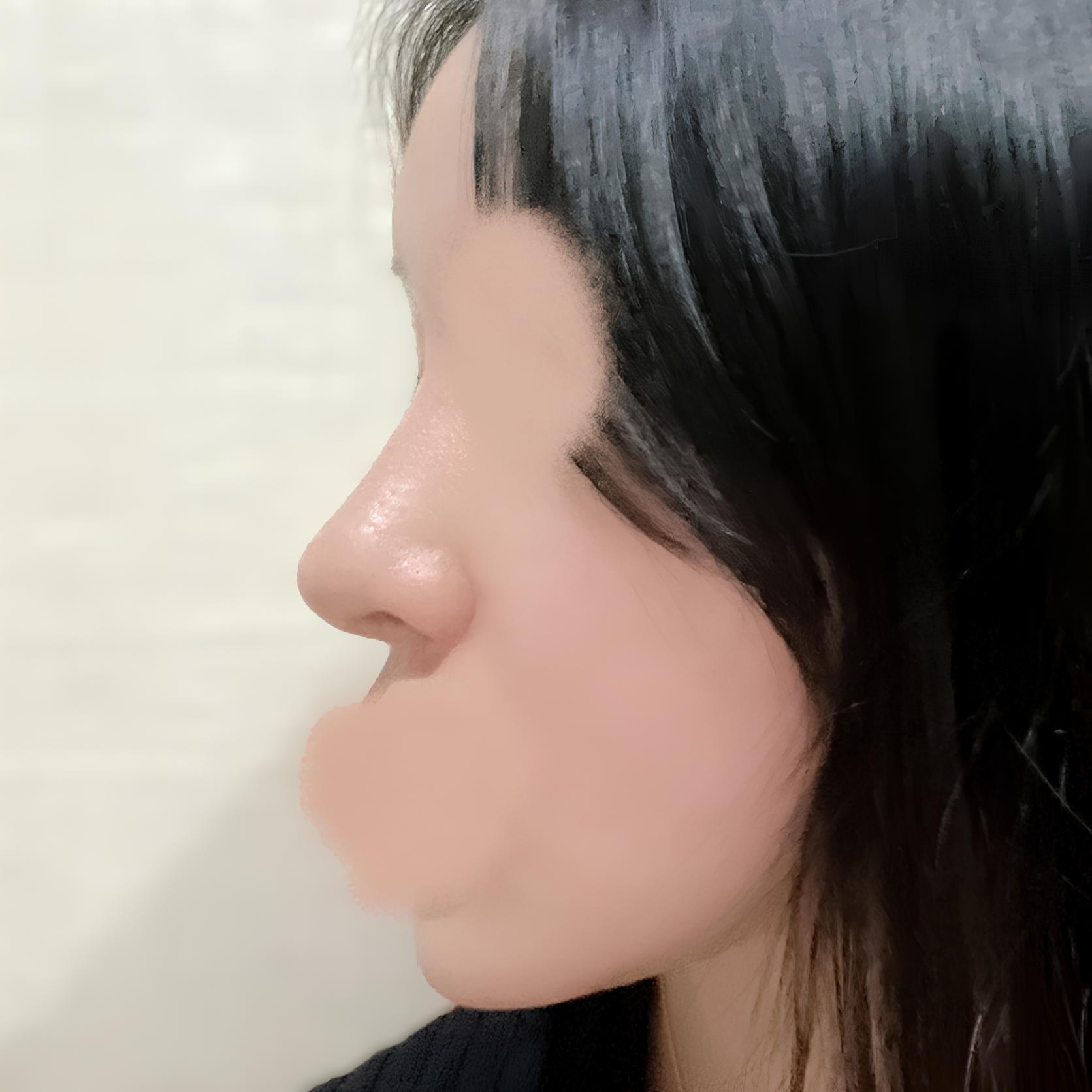 団子鼻からすっきりした直半ライン鼻へ