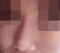 ただ大きかった鼻がきれいに整いました ㅎ