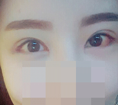 目の再手術+目尻切開+たれ目形成+目頭切開レビュー+_+