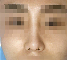 男性鼻手術から2か月経ったレビューです。