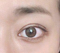 目の手術、どうですか？自然にきれいになりましたよね？？