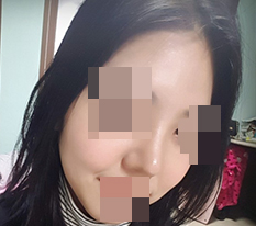 短くてぽってりした団子鼻を現代美学整形外科で綺麗に変えてもらいました^_^