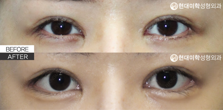非切開涙袋形成 + デュアル目尻切開（再手術）