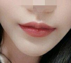 口角挙上 待望の6ヶ月経過報告 ㅜㅜㅜㅜㅜㅜ