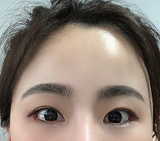 額リフト3か月目です