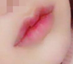 I highly recommend 現代美学整形外科 mouth-corner + Cupid lip surgery