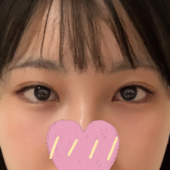 小さく詰まった目の目尻切開と二重再手術のレビューです