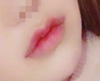 唇の整形って不思議~~ 