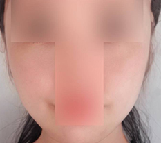 Cheek sagging solved!!