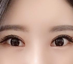 眼瞼下垂矯正なら現代美学整形外科