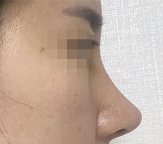 知人の紹介で現代美学整形外科で鼻手術を受けました