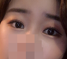 二重があるから目の整形をしないのは本当に損だと思いますㅋㅋ (デュアル切開+目頭切開レビュー)