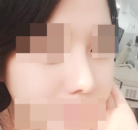鼻整形最高！大満足です♥!!