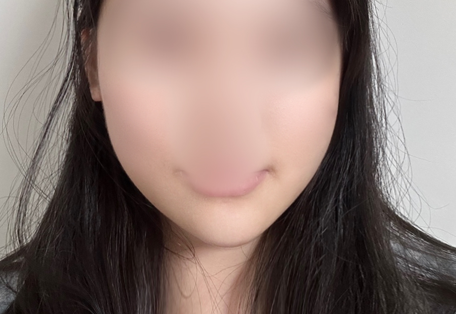糸リフトで顔の左右差を整えました