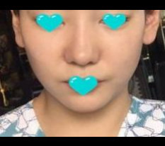 鼻がきれいになって嬉しいです!