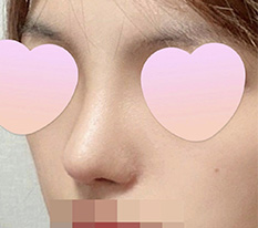 鼻をやった満足度が本当にすごく高い気がします ><