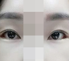 目尻切開・下眼瞼切開 ♥~