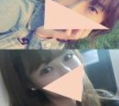目の再手術！現代美学整形外科で成功しましたㅎㅎㅎㅎ