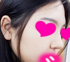 カボチャみたいな鼻からキュウリみたいな鼻へ lol