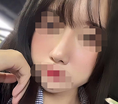 低い鼻の解決
