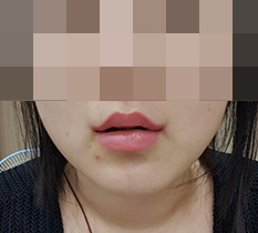 口角整形しました〜〜