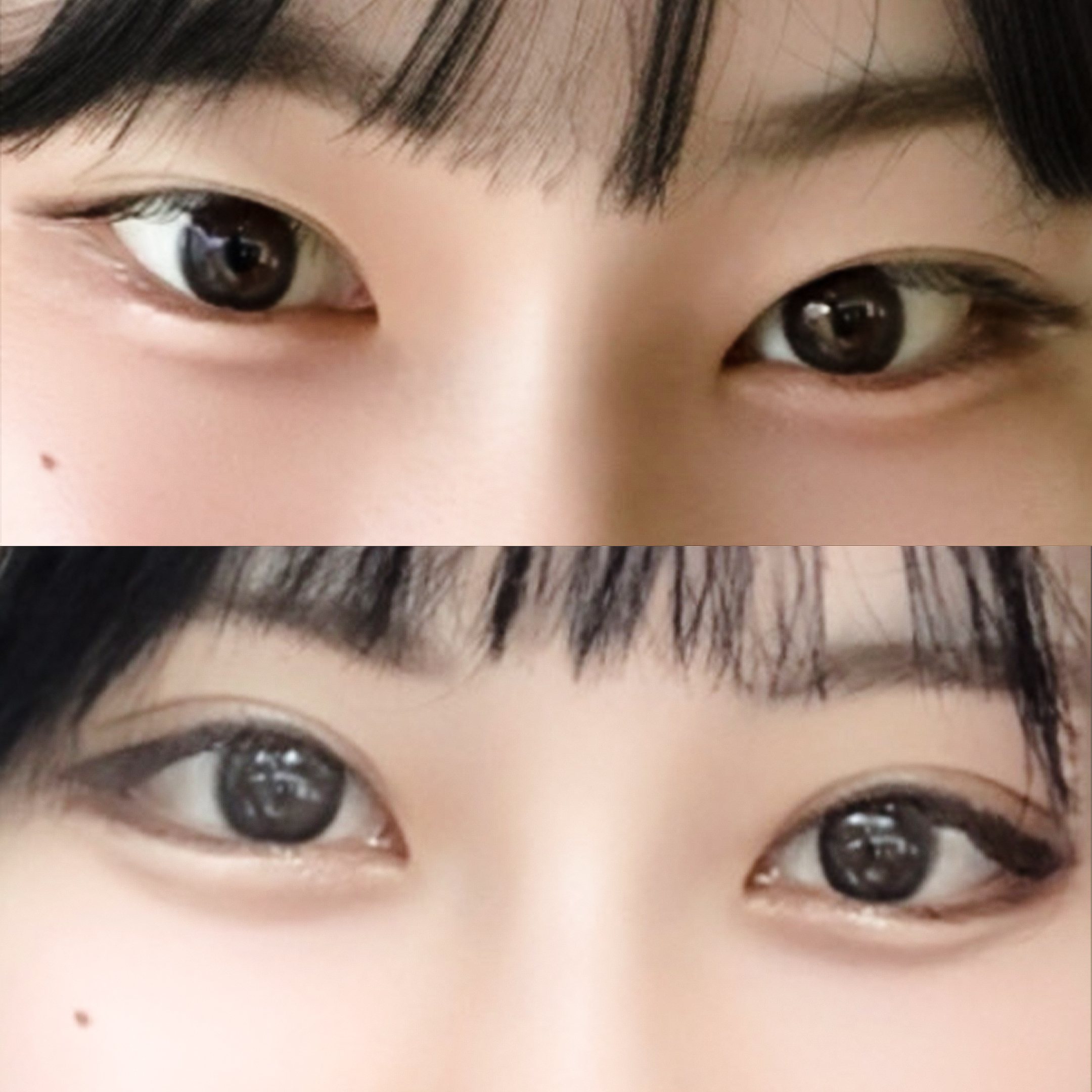 目の再手術とデュアル切開で優しい目元に