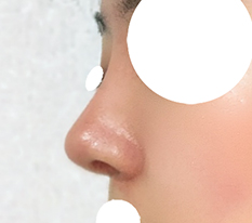 Made a straight-slope nose with donated rib cartilage!!