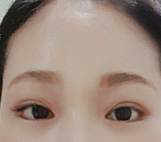 額リフトでくっきりして良かったです^^