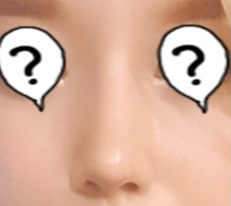 My unattractive nose changed my whole image after rhinoplasty at 現代美学整形外科!