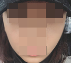 頬骨縮小をしたら印象が本当に変わりました♥