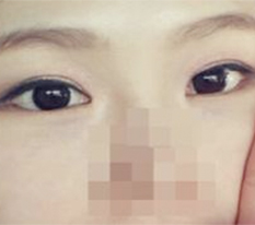 目の整形、満足レビューです^.^/