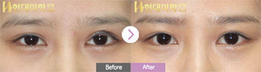 目の切開再手術、眼瞼下垂矯正