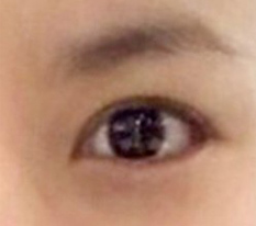 目の再手術から1か月でもこれなら成功だと思います