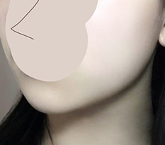 あご肉の整理完了