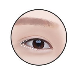 下眼瞼拡大術 1段階 — 適した目尻をデザイン